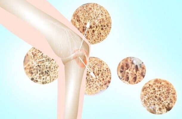 Dấu hiệu loãng xương sớm ít người để ý: Cảnh báo thầm lặng của sức khỏe xương